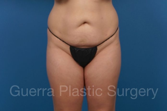 Tummy Tuck Case #35640 - before