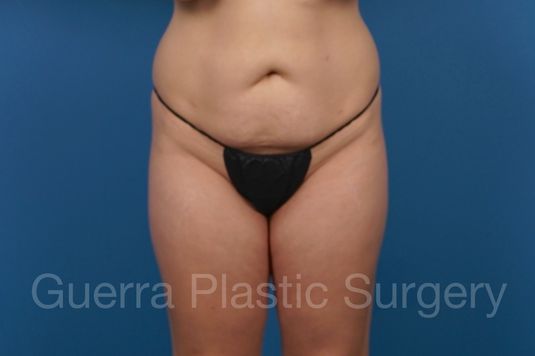 Before Photo Tummy Tuck