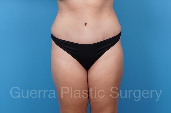 Tummy Tuck Case #35640 - after