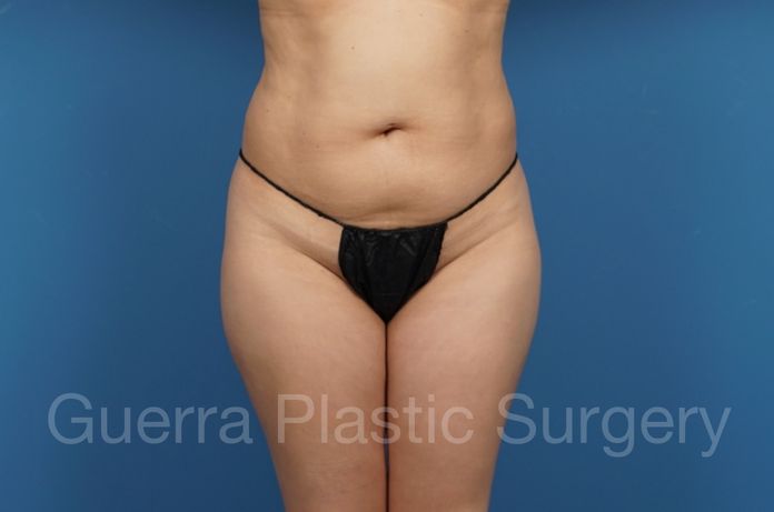 Tummy Tuck Case #34553 - before