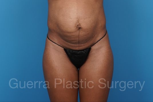 Before Photo Tummy Tuck