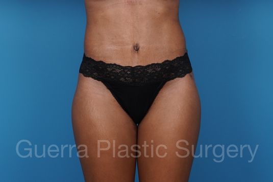 After Photo Tummy Tuck