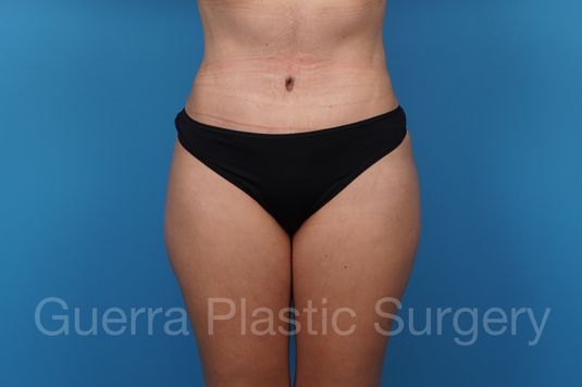 After Photo Tummy Tuck
