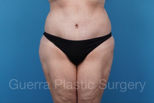 After Photo Tummy Tuck