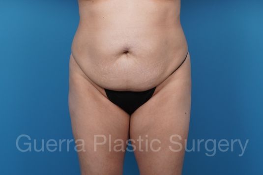 Before Photo Tummy Tuck
