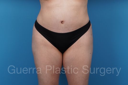 After Photo Tummy Tuck
