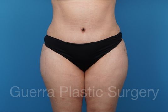 prev Case #39172 After