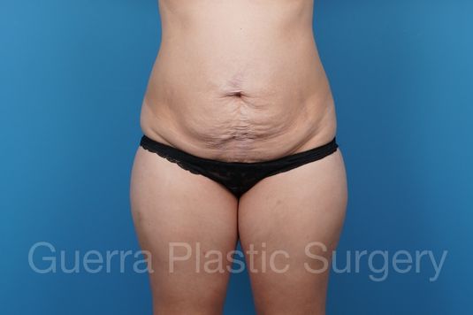 Before Photo Tummy Tuck