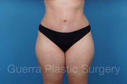 After Photo Tummy Tuck