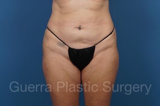 Before Photo Tummy Tuck