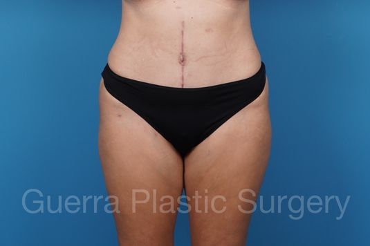 After Photo Tummy Tuck