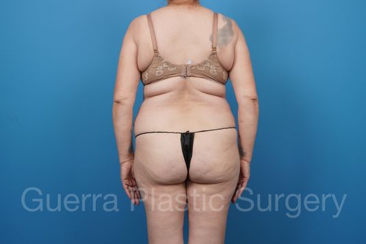 Before and After photo - Tummy Tuck - Case #40912