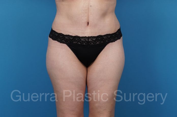 Tummy Tuck Case #40912 - after