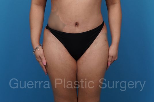prev Case #34861 After