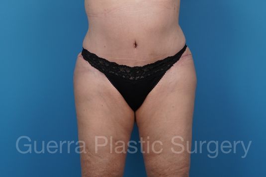 next Case #42839 After