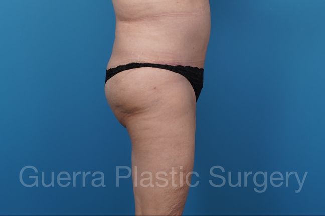 After Photo 6