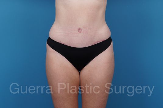 prev Case #43076 After