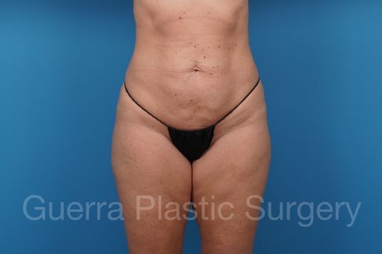 next Case #42903 Before