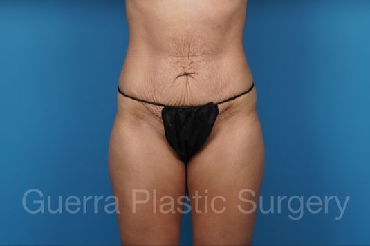 Before Photo Tummy Tuck