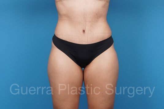 After Photo Tummy Tuck
