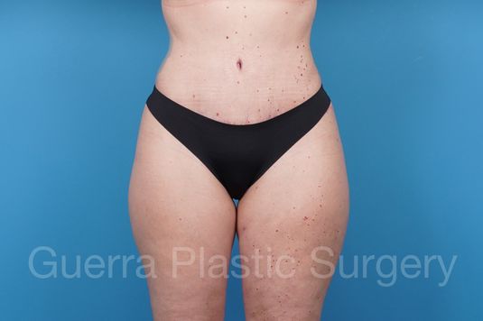 prev Case #43613 After