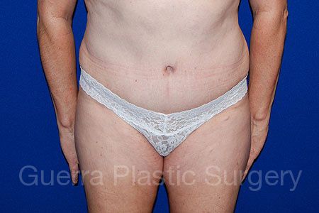 prev Case #30139 After