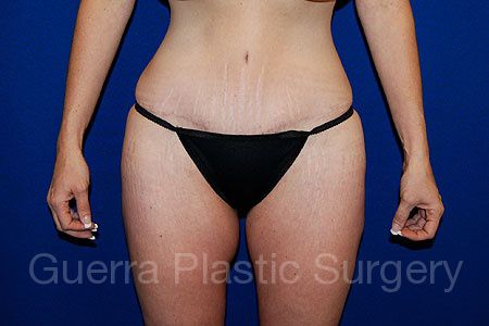 prev Case #18623 After