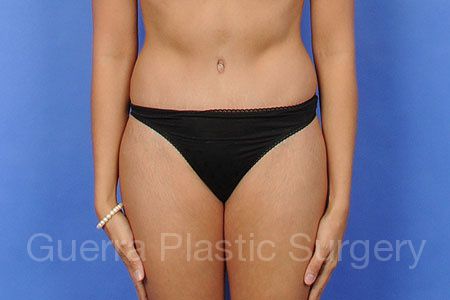 prev Case #31125 After