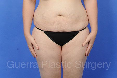 next Case #343442 Before