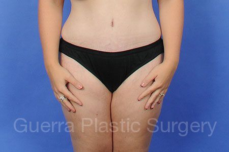 next Case #343442 After