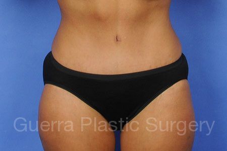 prev Case #30222 After