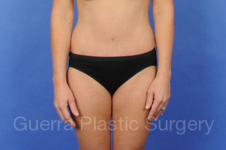 next Case #303392 After