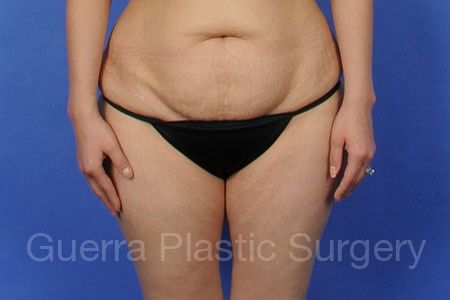 Before Photo Tummy Tuck