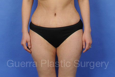 After Photo Tummy Tuck
