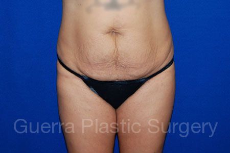 Before Photo Tummy Tuck