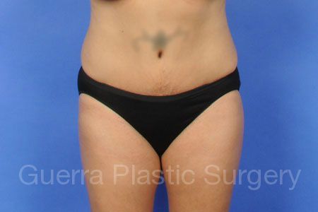 After Photo Tummy Tuck