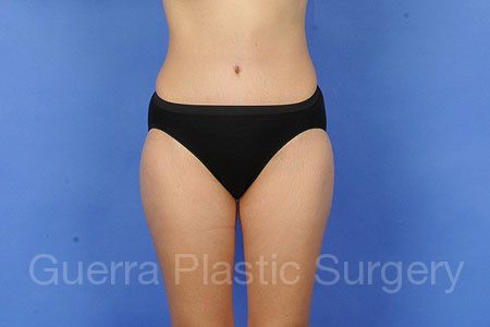 prev Case #33091 After