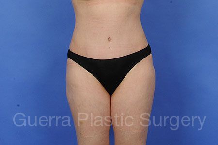 prev Case #86695 After