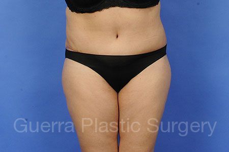 prev Case #78235 After