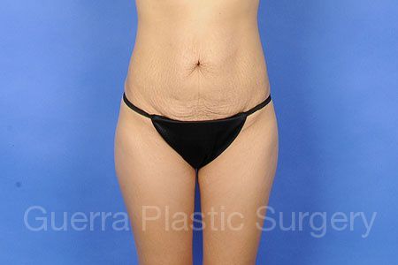 next Case #33655 Before