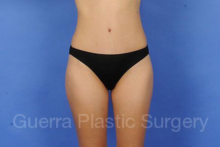 next Case #33655 After