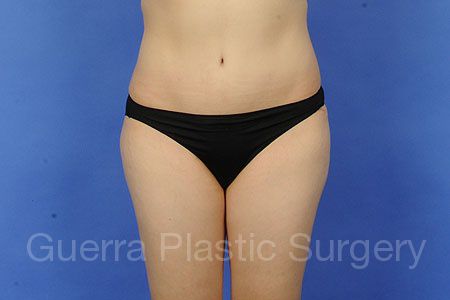 next Case #63995 After