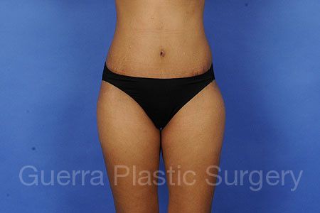 prev Case #85641 After