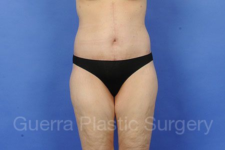 prev Case #49732 After