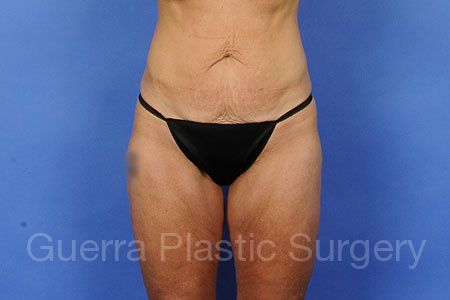 prev Case #54781 Before