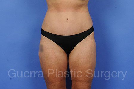 prev Case #54781 After