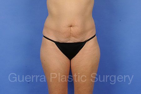 next Case #33548 Before