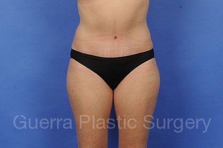 next Case #33548 After