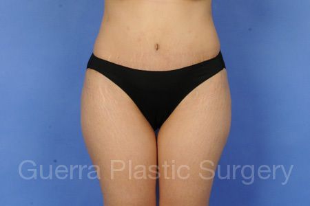 prev Case #99688 After