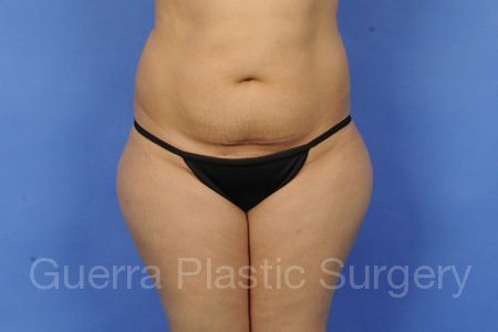 next Case #38965 Before